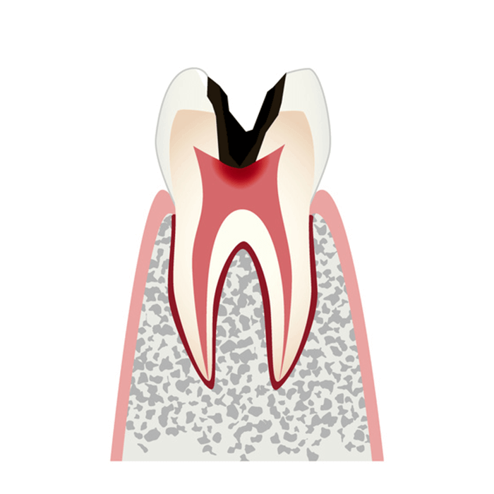 神経まで虫歯が進行している虫歯