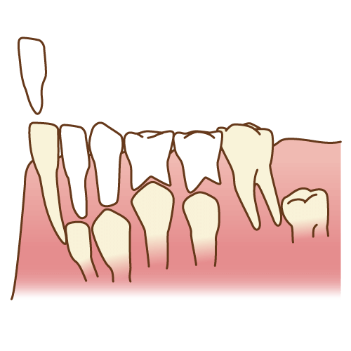生え変わったばかりの永久歯は特に虫歯に注意