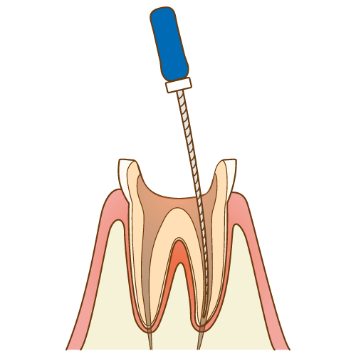 歯根の清掃