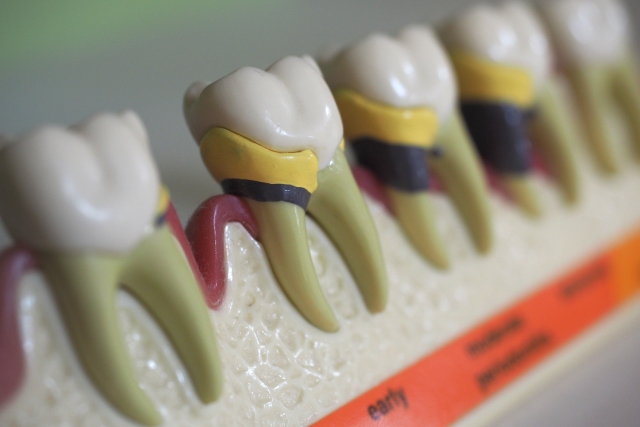 歯周病の進行段階を示す模型画像